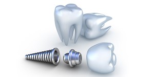 تاریخچه دندانپزشکی ایمپلنت و قرارگیری آن در استخوان