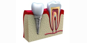 implant