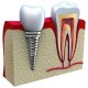 implant