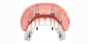 implant