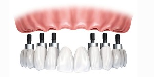 implant
