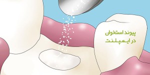 نکات جراحی برای پیوند استخوان