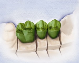 روش های قالب گیری و اصول ساخت پروتز