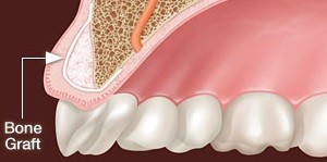 Bone Grafting