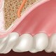 Bone Grafting