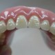 Replacing all teeth with a removable prosthesis