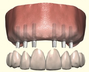 Replacing all teeth with a fixed prosthesis