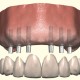 Replacing all teeth with a fixed prosthesis