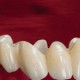 Dental Crowns