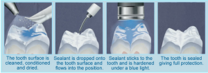 fissure sealants