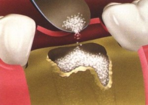 Bone Grafting