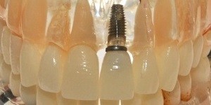 Implant Problems