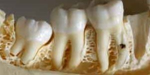 Effect of implant design and i bone densityn primary stability