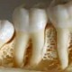 Effect of implant design and i bone densityn primary stability