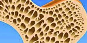 Bone Augmentation