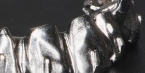 Corrosion in Titanium Dental Implants/Prostheses