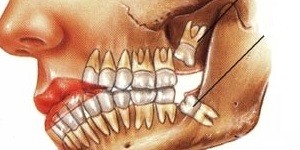 عفونت های فضای زیر فکی