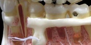 طبقه بندی تراکم استخوان جهت انجام ایمپلنت