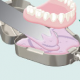 Fabrication of Palatal Template from Existing Prosthesis