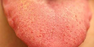 ضایعات و توده های خوش خیم و بدخیم سطح زبان