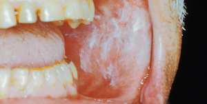 benign lump on tongue