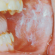 benign lump on tongue