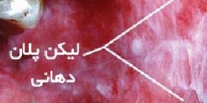 معرفی انواع دیگری از بیماری های زبان