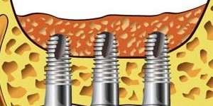 تاریخچه جراحی سینوس