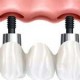 Bridging the Gap With Dental Implants