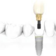 دندانپزشکی مدرن و استفاده از پروتزهای گوناگون