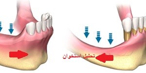طرح درمان و بررسی تحلیل استخوان بیمار جهت ایمپلنت