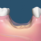 Osteoporosis and oral bone loss