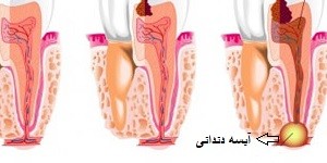 Dental Abscess Overview