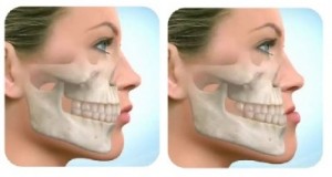 روش های ارزیابی ارتفاع عمودی اکلوزالی (OVD)