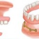Tissue-supported dental implant prosthesis or overdenture