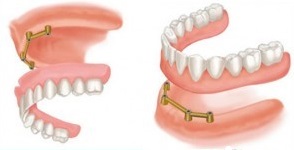 Tissue-supported dental implant prosthesis or overdenture