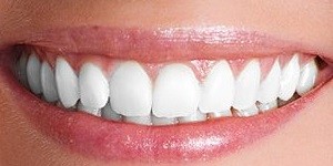 About of dental implants