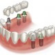 Tissue-supported dental implant prosthesis or overdenture