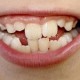 Dental Health With Crooked Teeth and Misaligned Bites