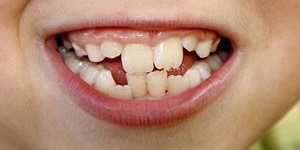 Dental Health With Crooked Teeth and Misaligned Bites