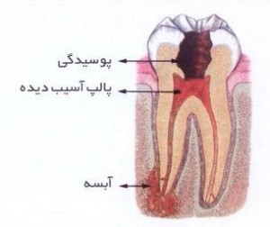 علم دندانپزشکی و کاهش پوسیدگی دندان