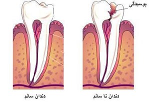 خطرات پرکردن دندان