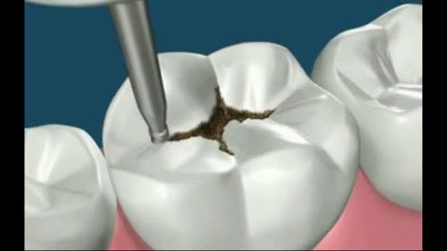 پرکردن دندان ممنوع