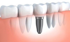 حقایقی باورنکردنی از ایمپلنت