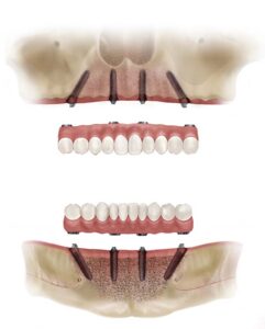 ایمپلنت All-on-4