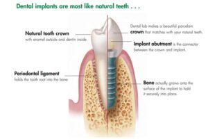 دندان های طبیعی و ایمپلنت دندان