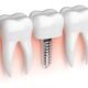 شکل و ساختار ایمپلنت دندان