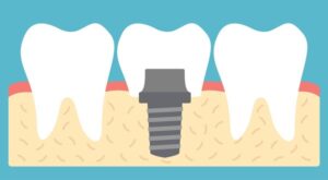ایمپلنت کردن دندان
