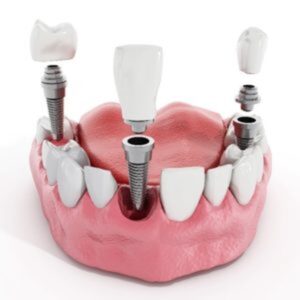ایمپلنت دندان بدون درد | دردناک بودن ایمپلنت دندان