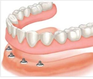 Implant-Retained Dentures